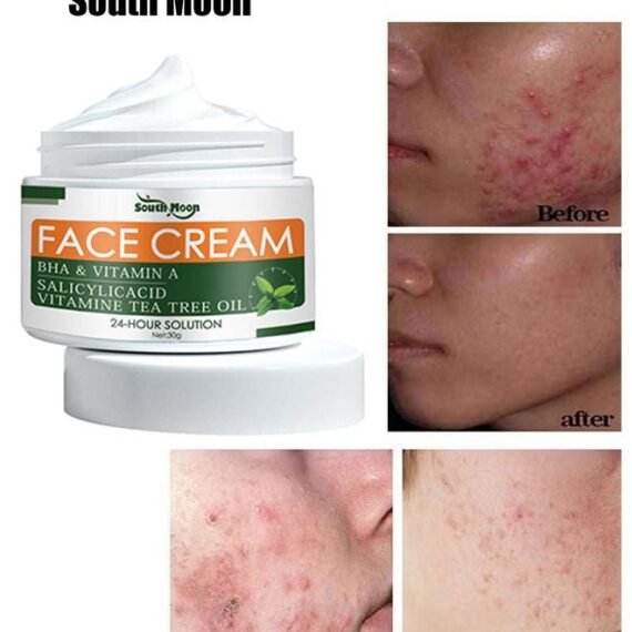 Acne Treatment Face Cream Acne Spot Treatment For Face And Acne Dots Natural Cystic Acne Treatment For All Skin Types Premium Acne Scar Cream And Pimple Remover 30ML